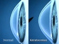 keratoconusEye.jpeg