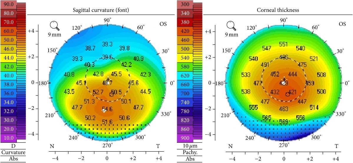 Corneal topography