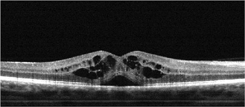 Diseased Retina OCT