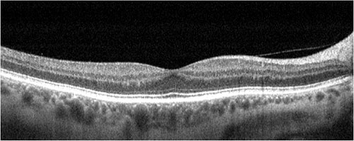 Normal Retina OCT