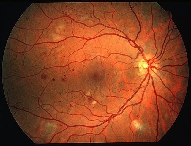 Retina Diabetes NPDR