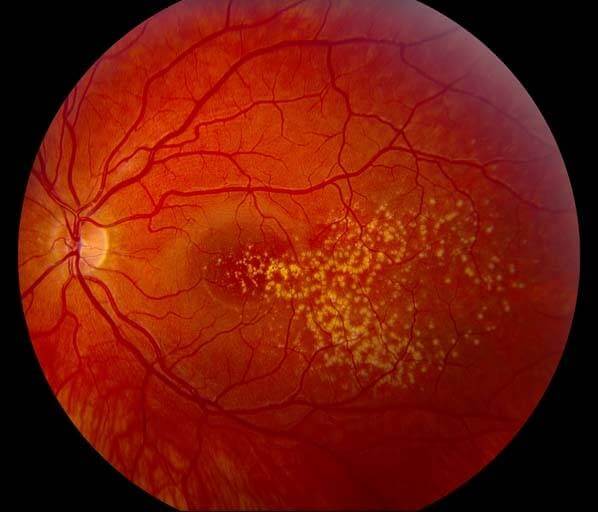drusen Macular Degeneration