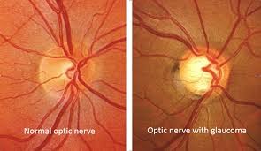 glaucoma