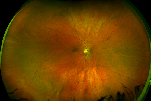 healthy retina