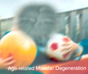 age related macular degeneration treatment
