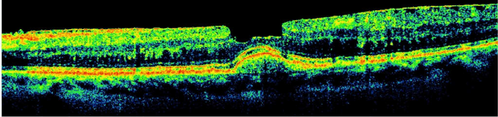 Diseased Retina iWellness 1 1024×241