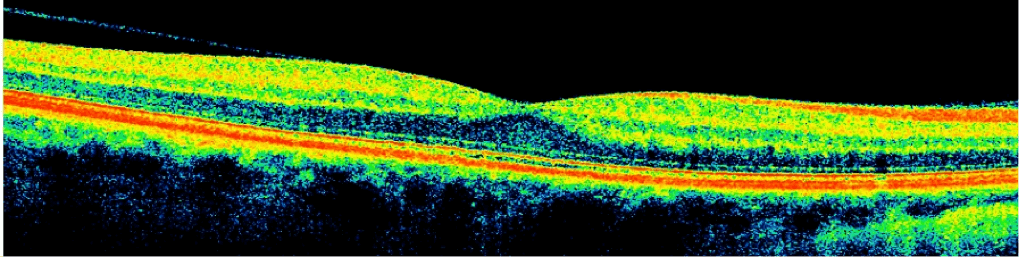 Normal Retina Cross Section iWellness