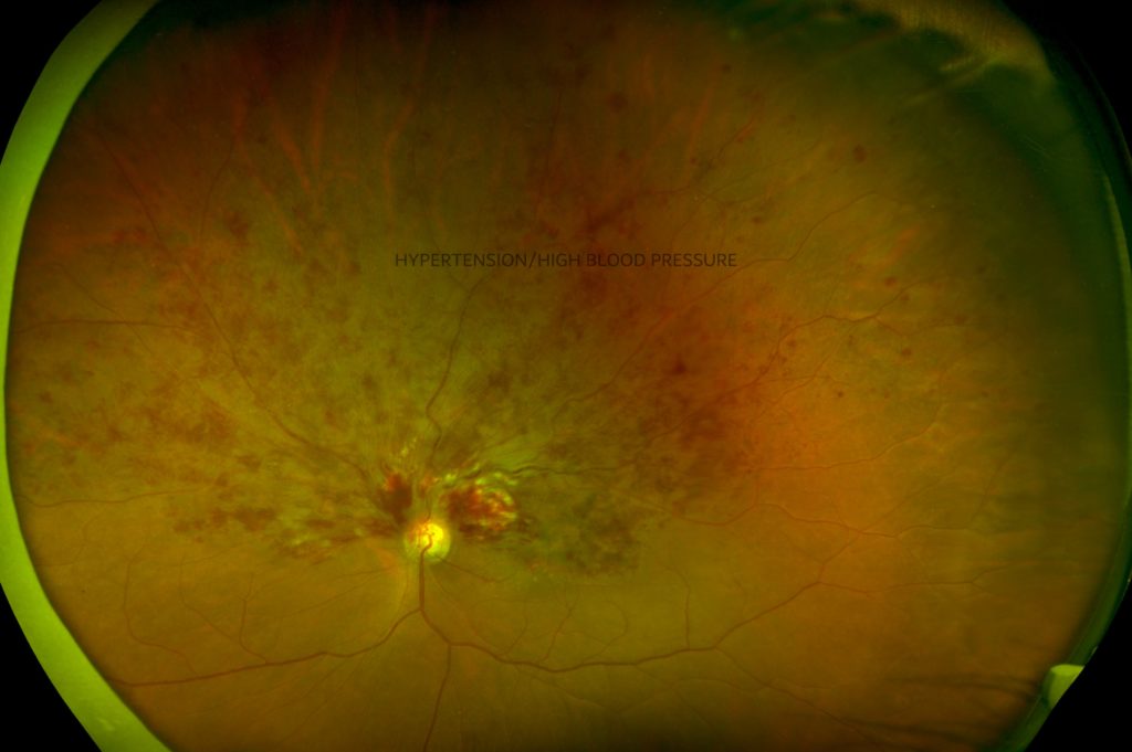 Diabetic Eye/Retinal Imaging