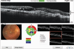 Retinal map