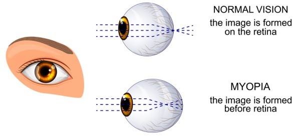 eye