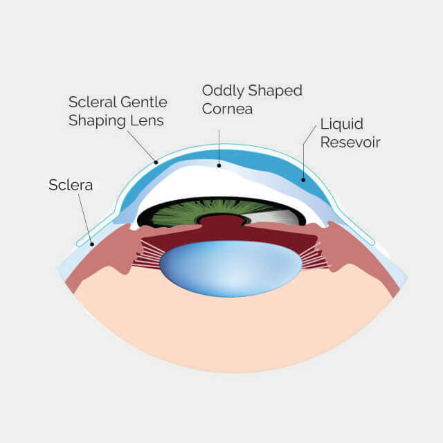 ScleralLens Diagram dark.jpg