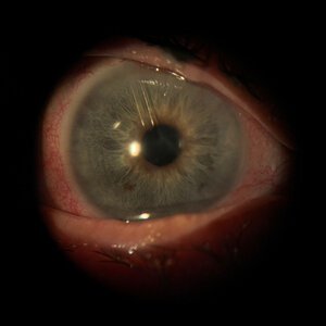 glaucoma+tube