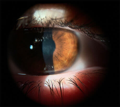 Corneal scar 02