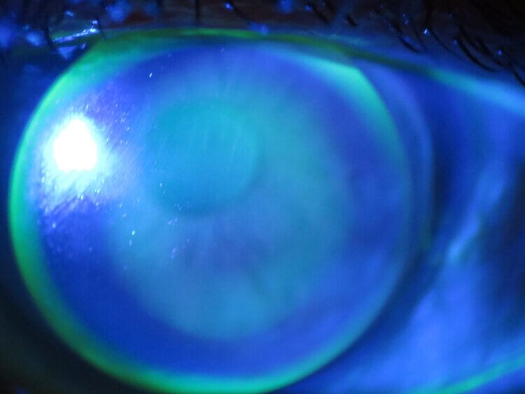 Contact+lens+corneal+GP+after+lasik2