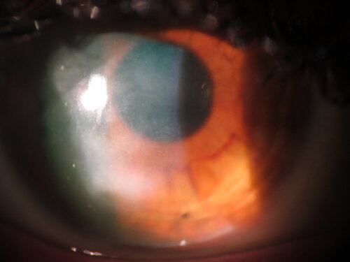 Corneal+scar+from+corneal+ulcer