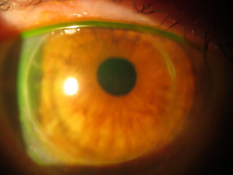 Keratoconus patient with Intacs