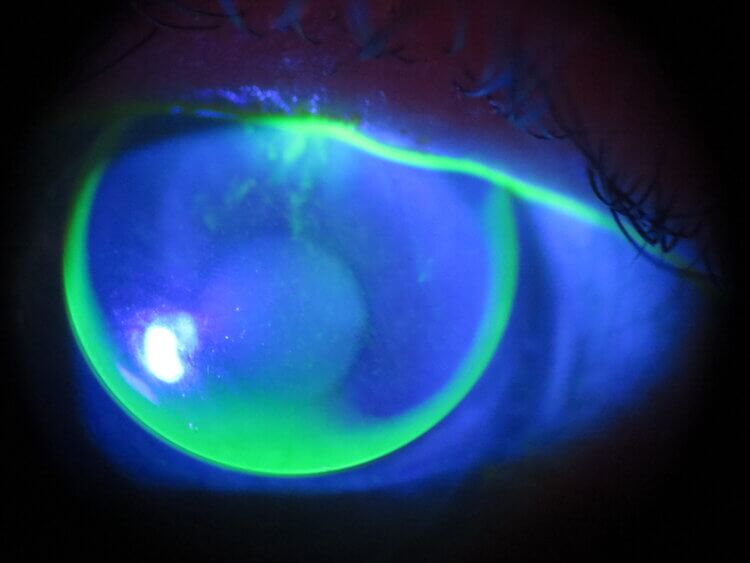 GP+lens+inferior+edge+lift+(2)