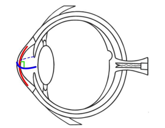 Irregular astigmatism