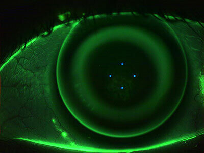 Orthokeratology