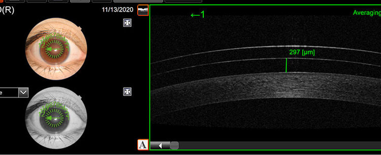 Scleral Lens Ocular Coherence Tomography