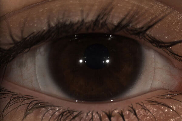 Scleral Lens On Eye