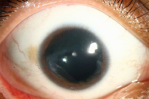 Keratoconus patient with Intacs