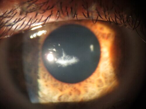 nico+french+keratoconus+scarring