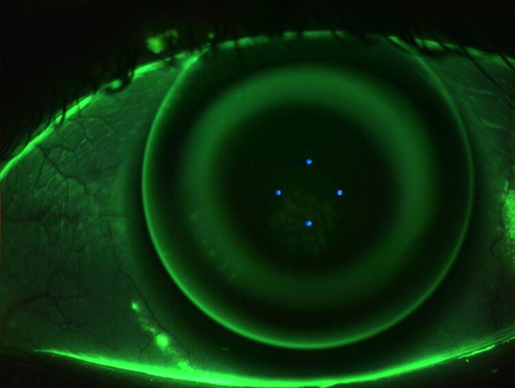 orthokeratology+lens+on+eye