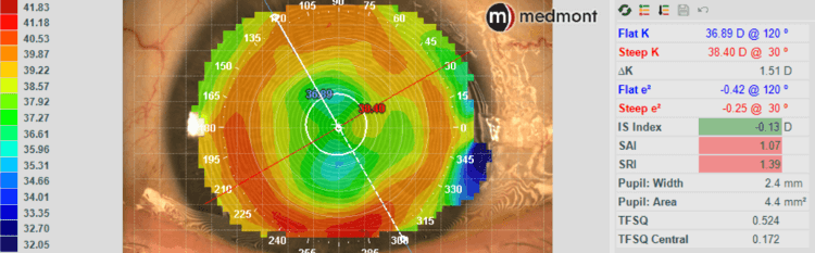 Keratoconus patient with Intacs