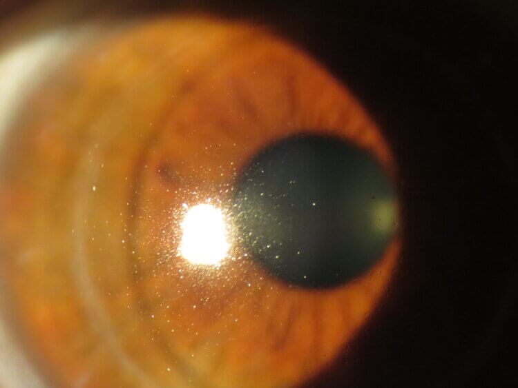 Keratoconus patient with Intacs
