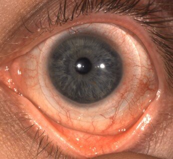 Keratoconus patient with Intacs