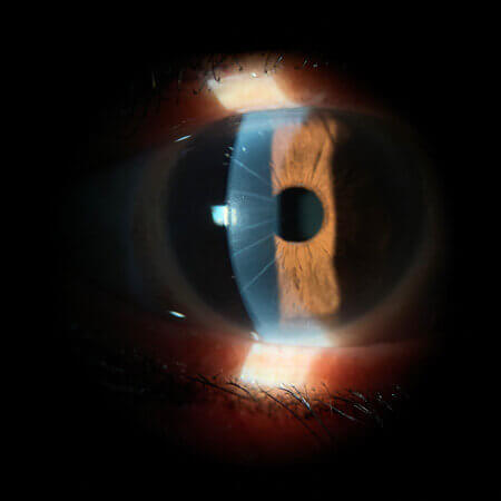 rk scarring