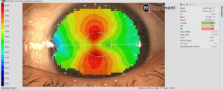 New Multifocal GP Lenses Improve Vision for 63-Year-Old