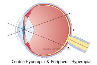 hyperopic eye