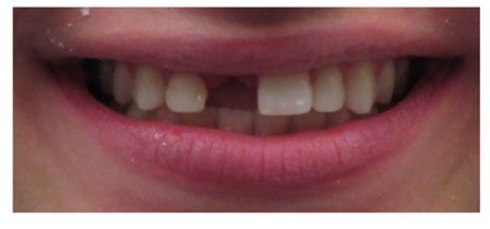 before dental implants