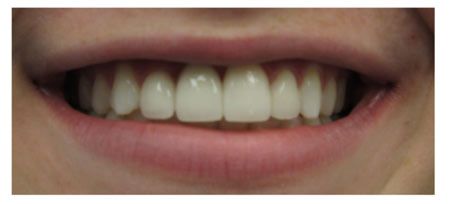after dental implants