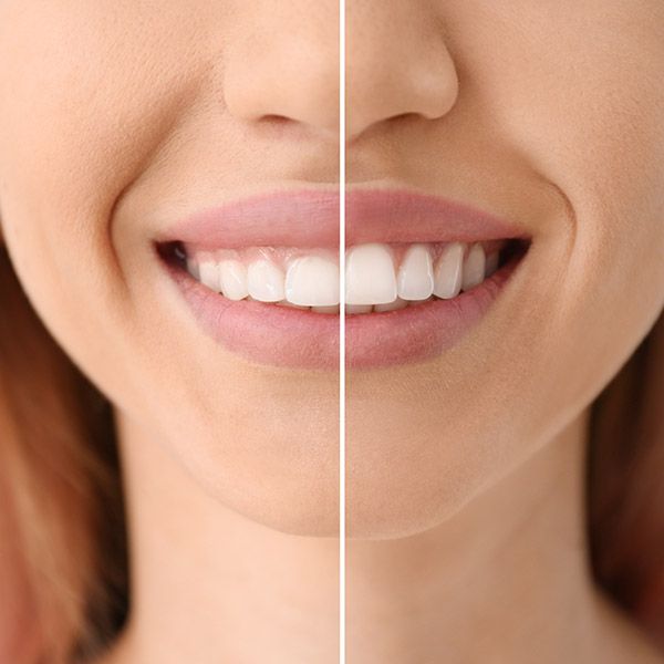 before and after gum contouring