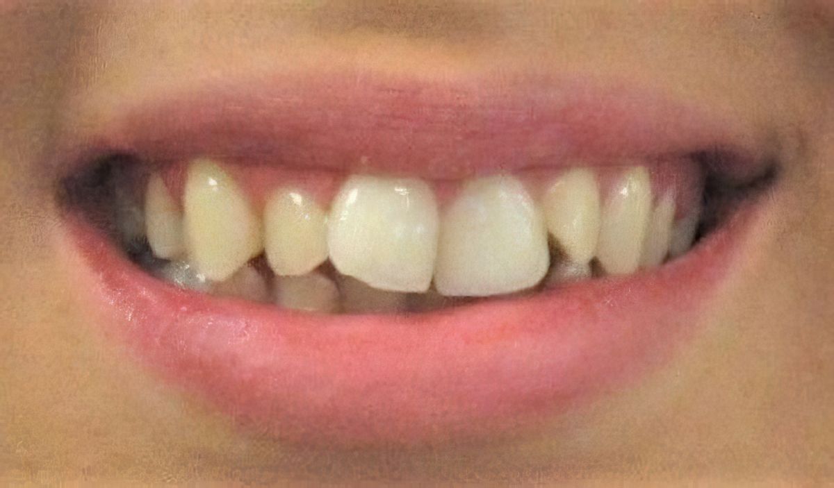 before and after invisalign