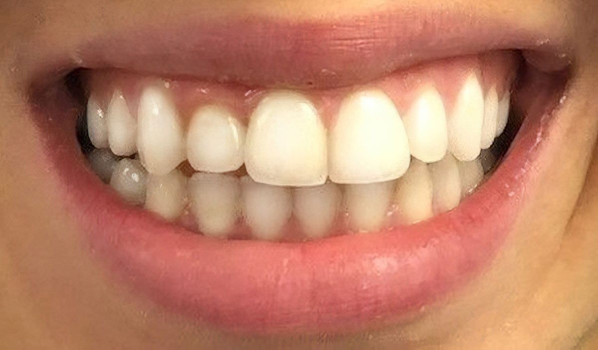 before and after invisalign