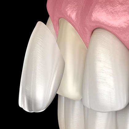 dental veneers