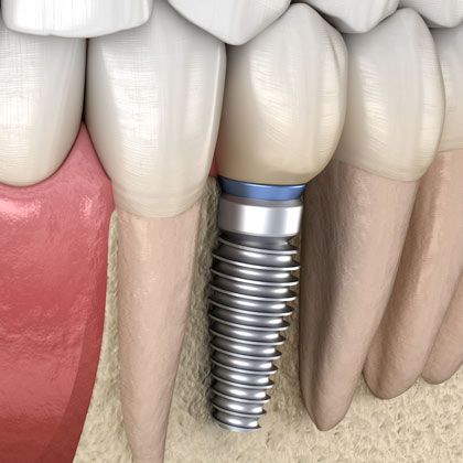 dental implants