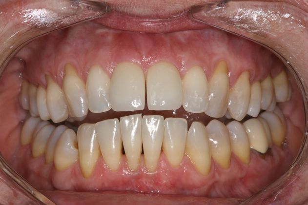 Victor R. Siegel, DDS After Dental Implants