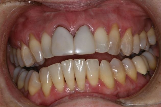 Patient at Victor R. Siegel, DDS Before Dental Implants