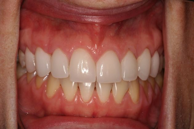 after veneers