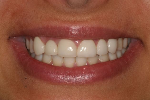 after veneers