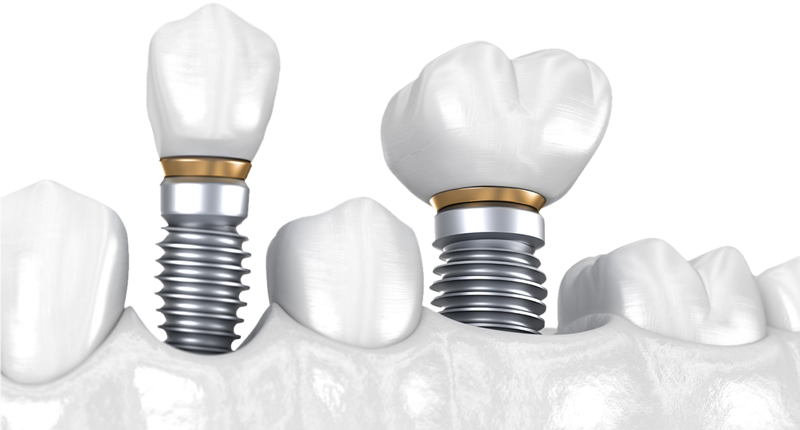 An illustration of two dental implant-supported crowns