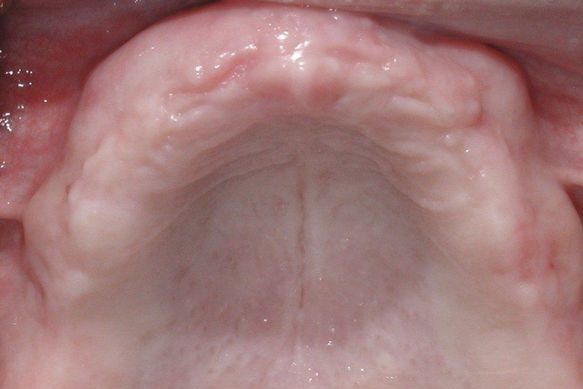 Before Dental Implants