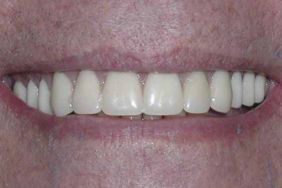 After Dental Implants