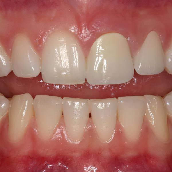 Before and After image of dental crowns