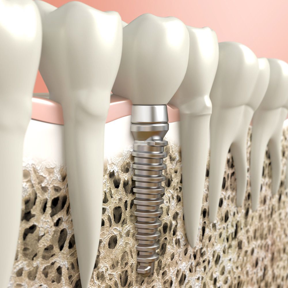 Dental Implants